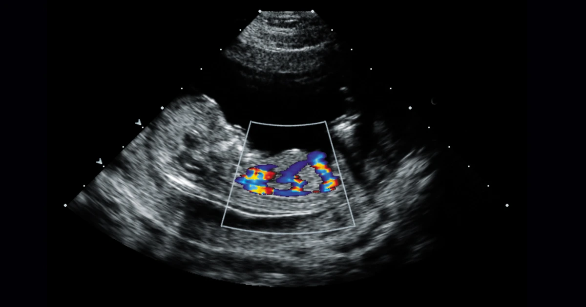 Fetal Echocardiography